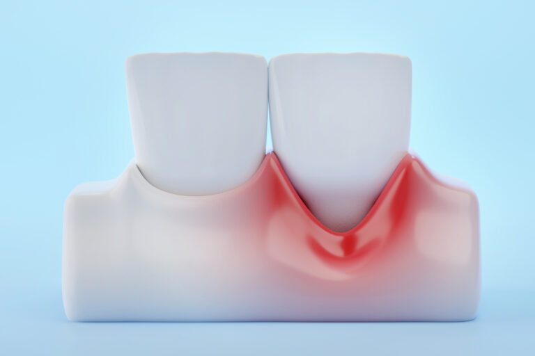 gum recession and front teeth on blue background